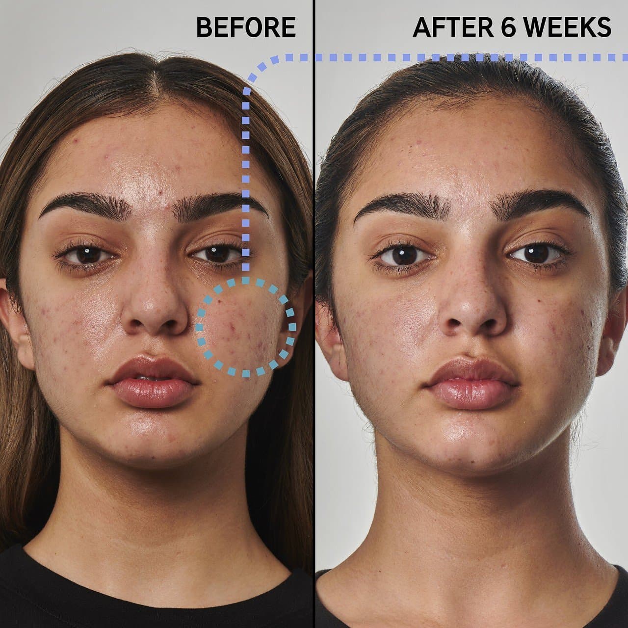 The inkey list Benzoyl peroxide acne solution | غسول بنزويل بيروكسيد لعلاج حب الشباب تركيز ٥٪